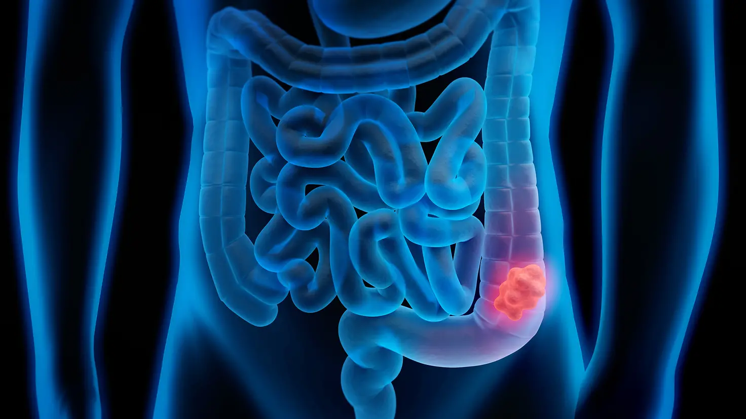 Die Illustration zeigt einen durchsichtigen menschlichen Körper mit einem Darm und einen Darm-Polypen.