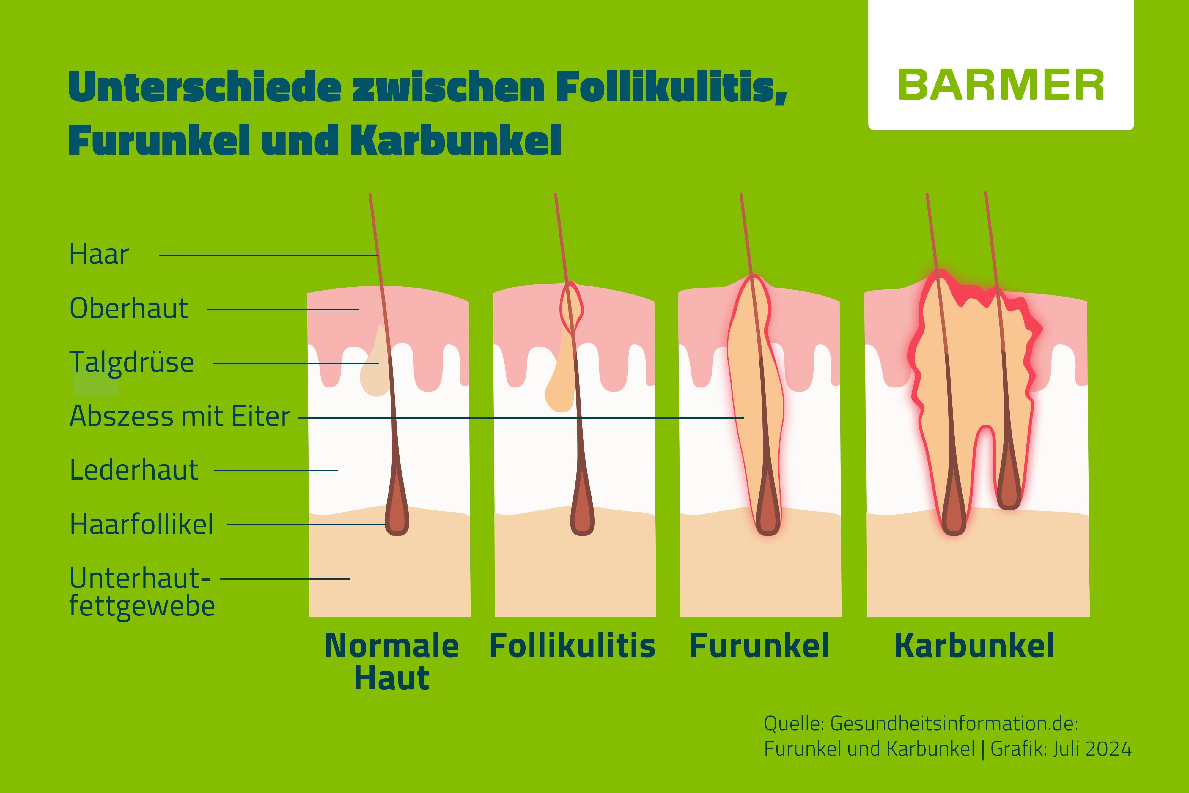 Infografik: Unterschiede zwischen normaler Haut, Follikulitis, Furunkel und Karbunkel - Darstellung der Hautschichten und Abszessbildung