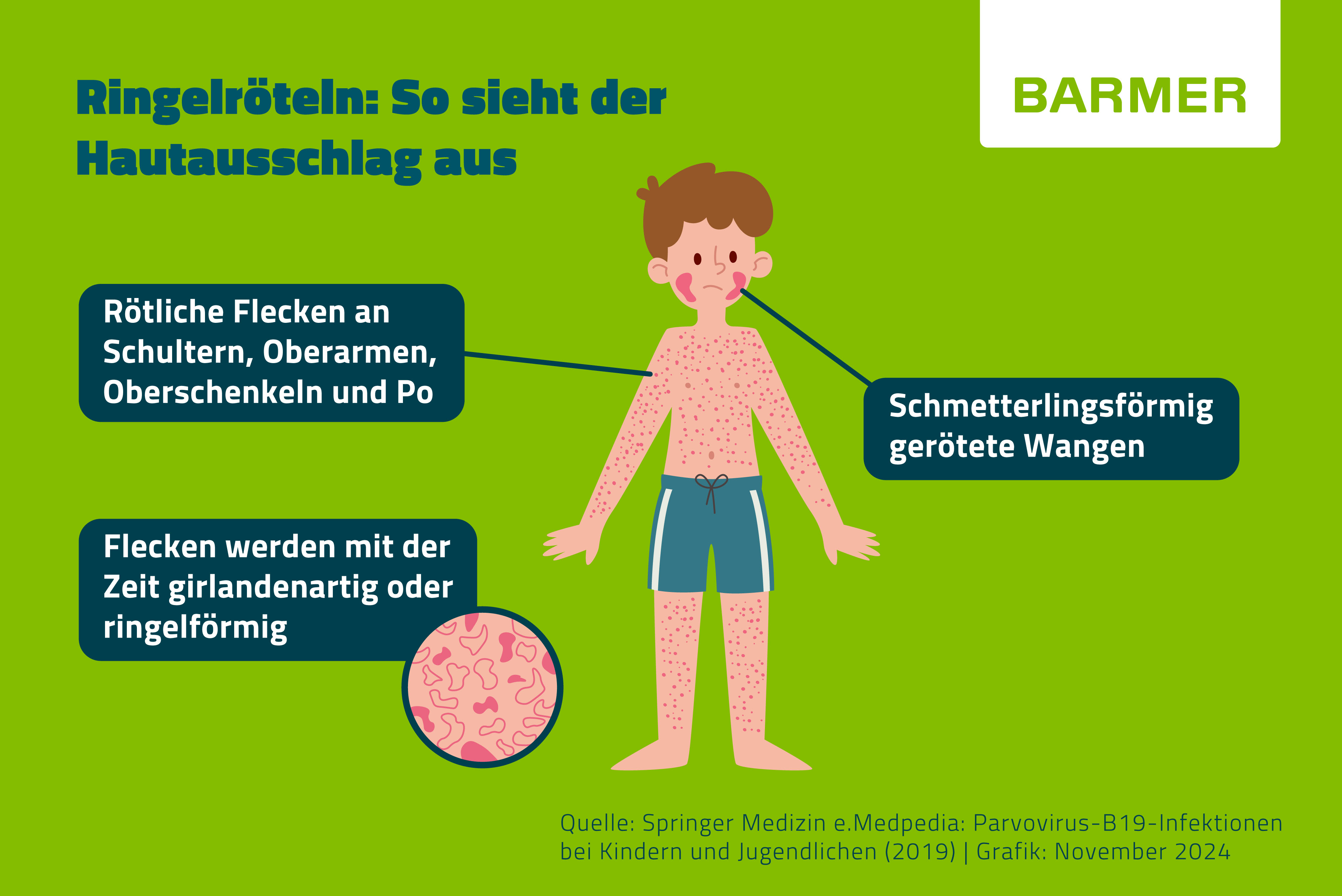  Diese Infografik zeigt die typischen Symptome des Hautausschlags bei Ringelröteln: schmetterlingsförmig gerötete Wangen, rötliche Flecken an Schultern, Oberarmen, Oberschenkeln und Gesäß sowie eine Detailansicht girlanden- oder ringelförmig werdender Flecken.