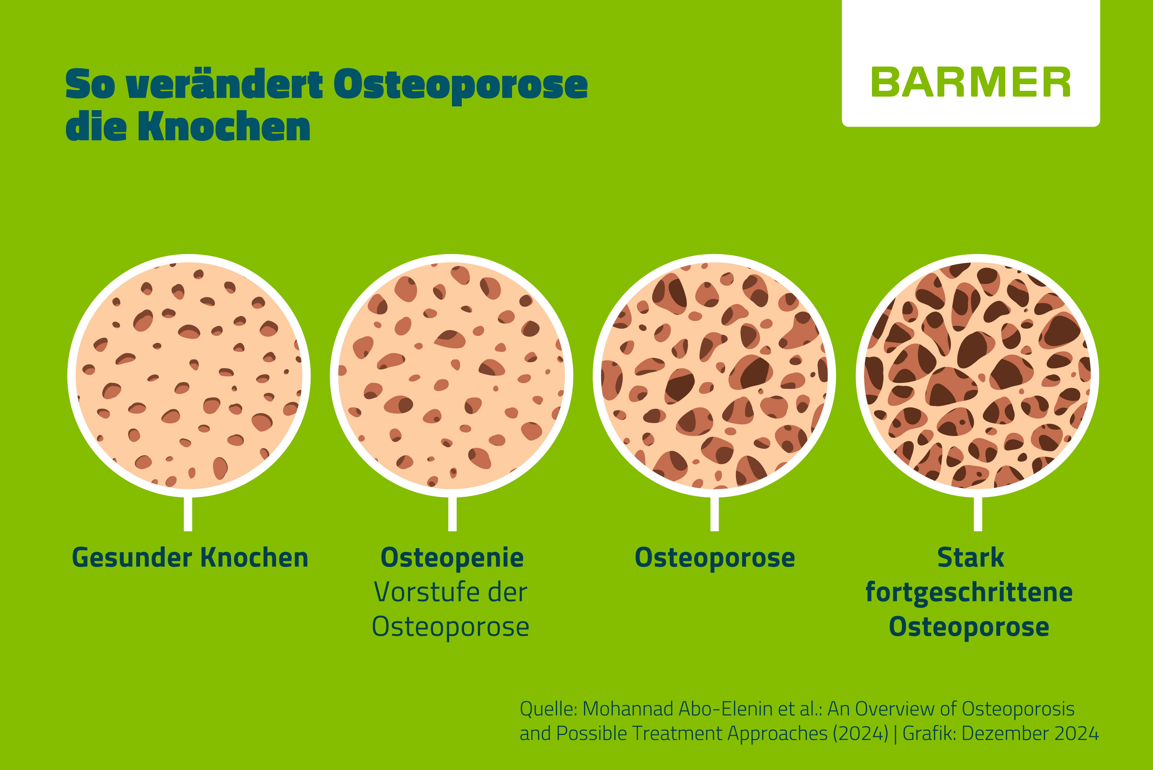 Infografik über die Auswirkungen von Osteoporose auf die Knochendichte. Gezeigt werden vier Stadien: Gesunder Knochen, Osteopenie (Vorstufe der Osteoporose), Osteoporose und stark fortgeschrittene Osteoporose, dargestellt durch Veränderungen der Knochenstruktur.